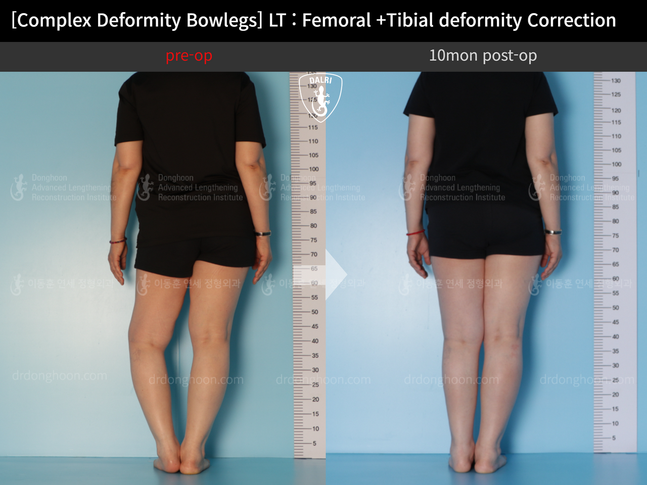 Before and after adult bowlegs, case 12790433, image 2, Dr. Donghoon institute (DALRI)