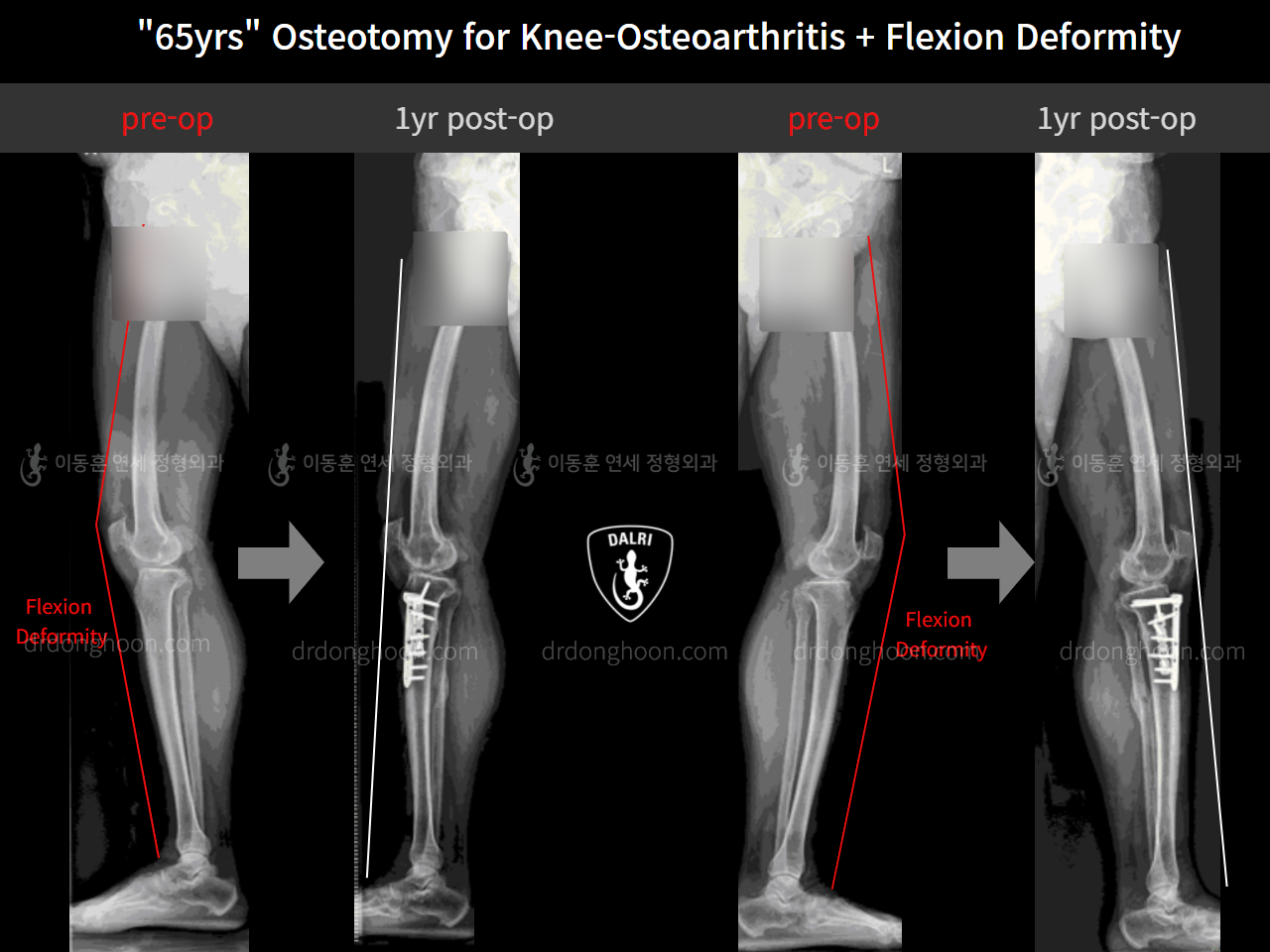 Before and after osteotomy for knee osteoarthritis, case 10742820, image 9, Dr. Donghoon institute (DALRI)