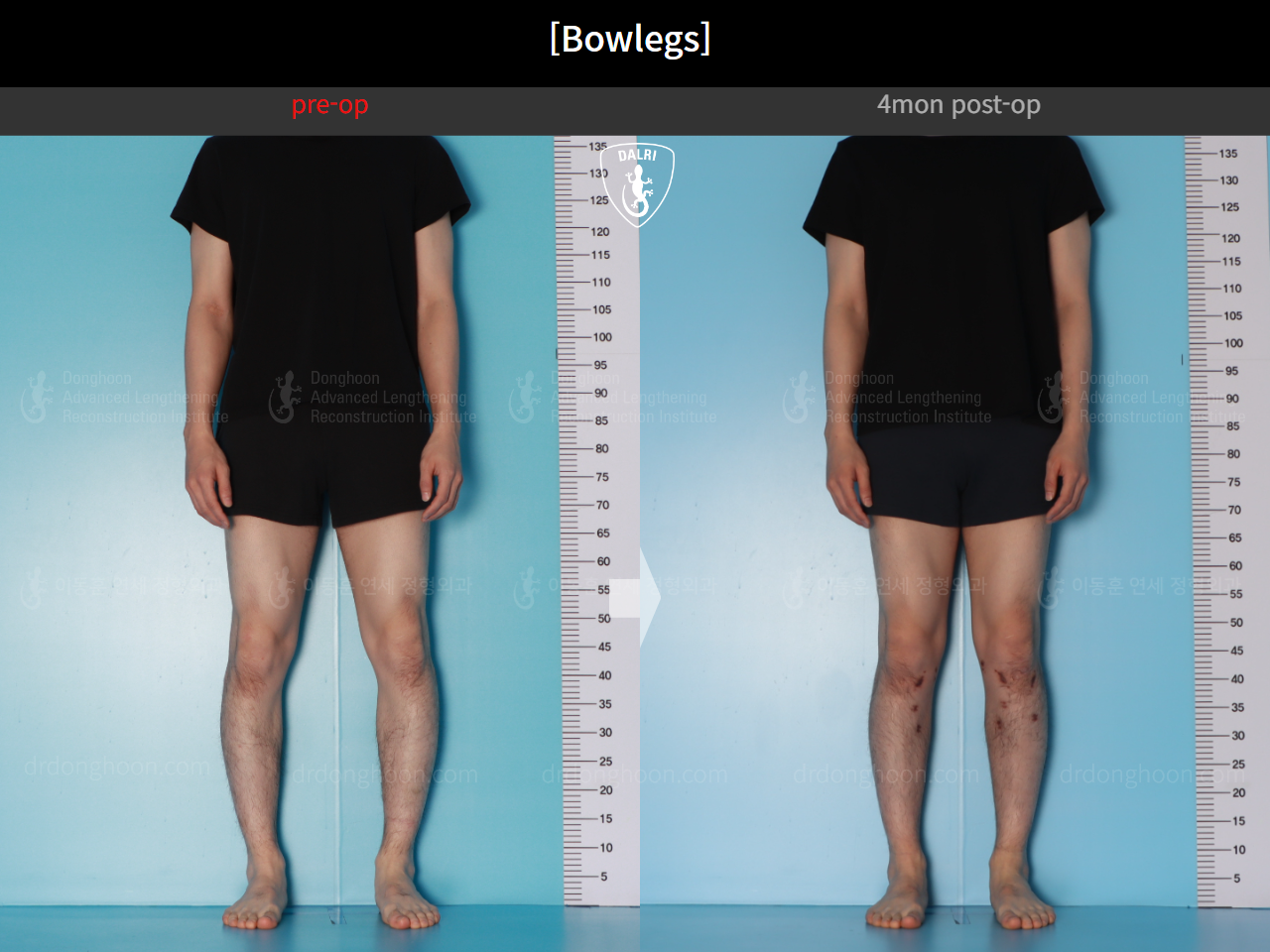 Before and after adult bowlegs, case 21098909, image 3, Dr. Donghoon institute (DALRI)