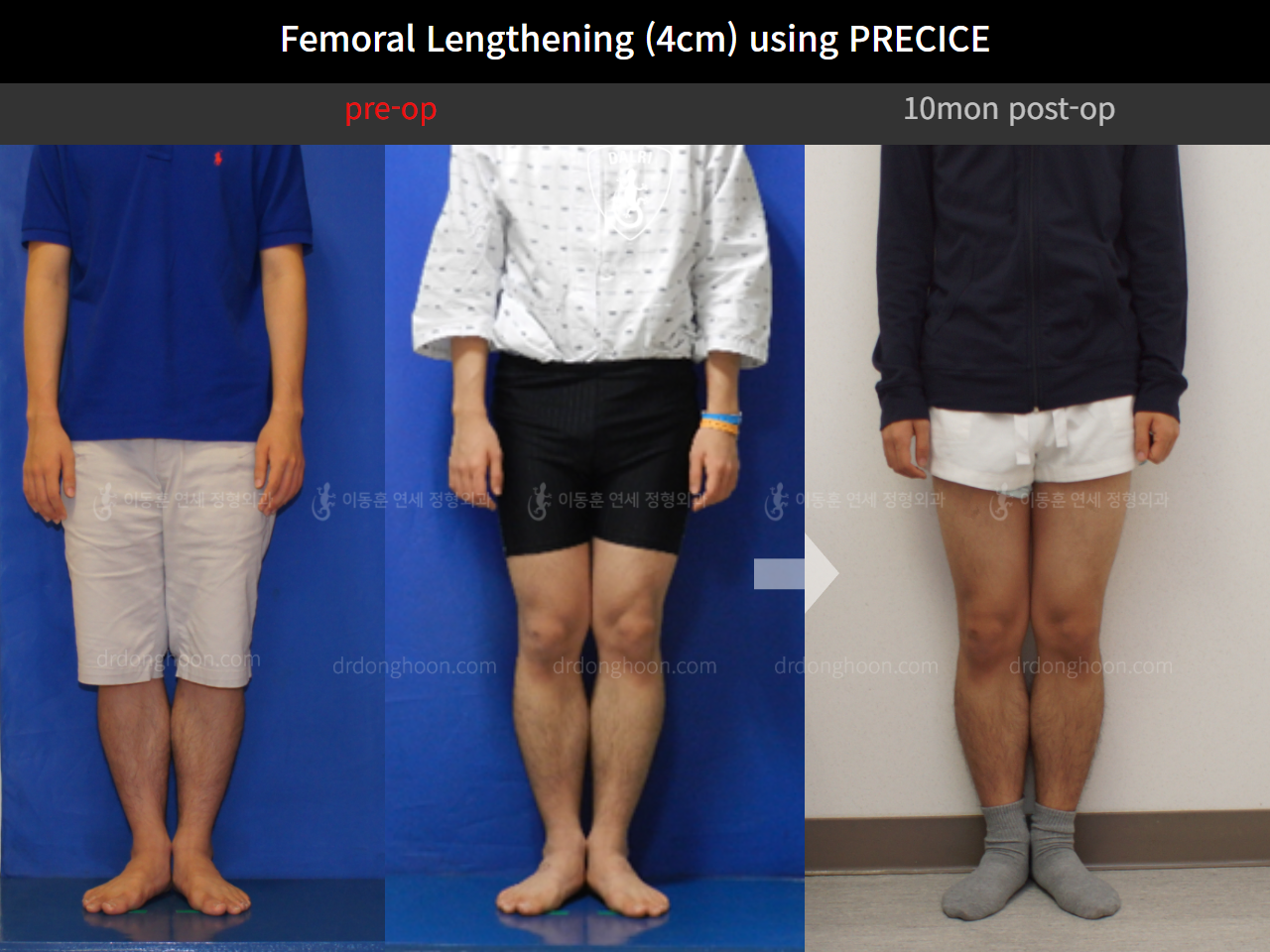 Before and after cll precice, case 4323369, image 2, Dr. Donghoon institute (DALRI)