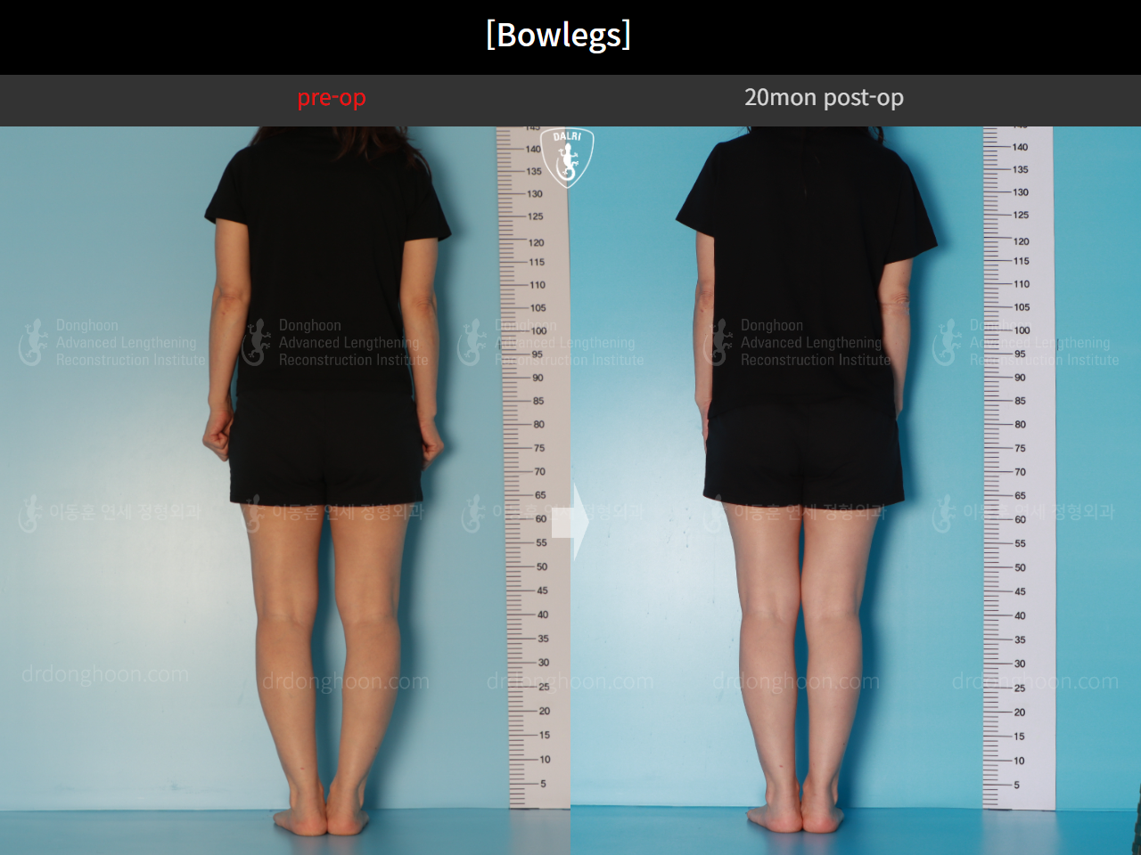 Before and after adult bowlegs, case 16724630, image 3, Dr. Donghoon institute (DALRI)