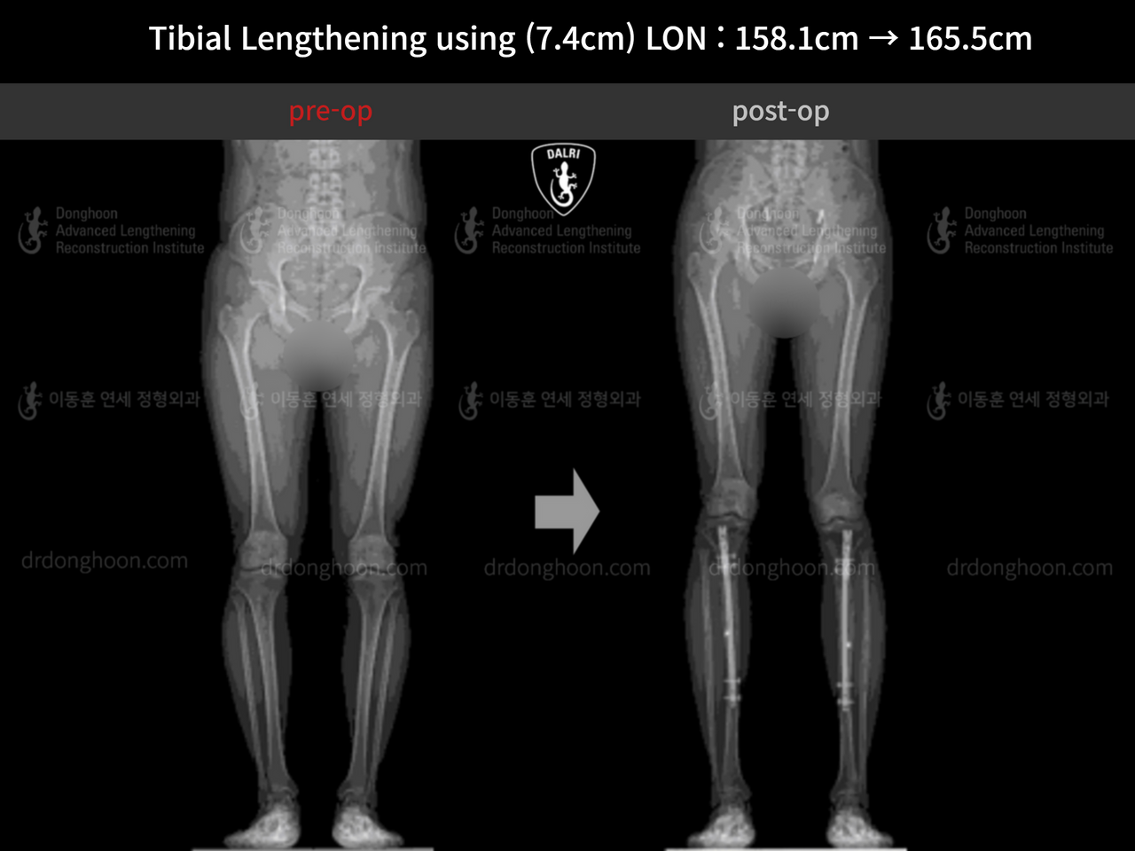 Before and after cll lon, case 12985247, image 2, Dr. Donghoon institute (DALRI)