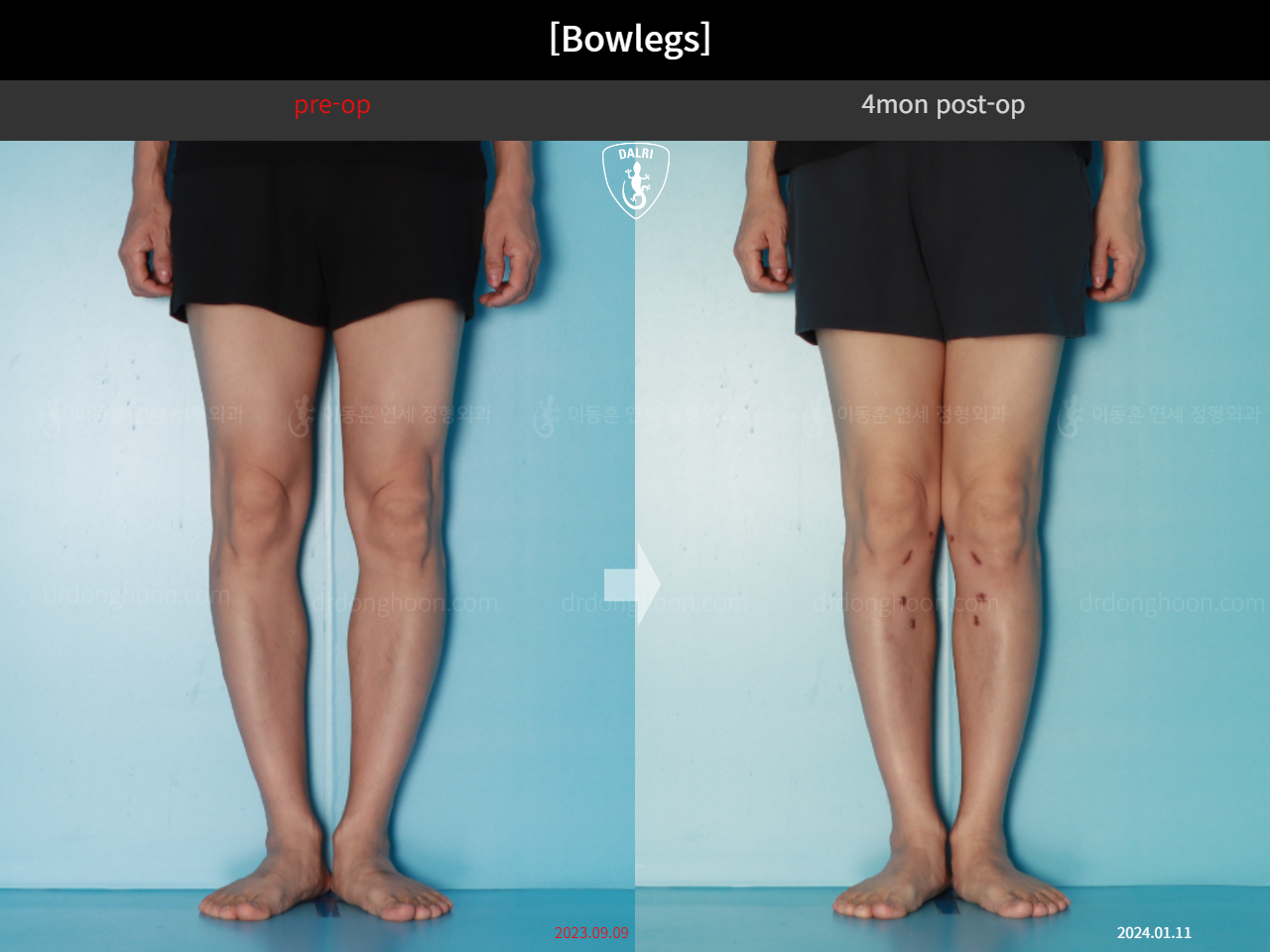 Before and after adult bowlegs, case 17962599, image 9, Dr. Donghoon institute (DALRI)