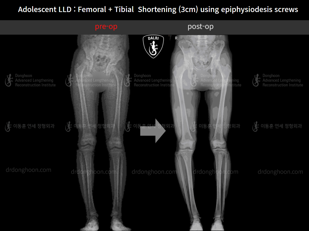 Before and after paediatric & adolescent lld, case 11511257, image 7, Dr. Donghoon institute (DALRI)
