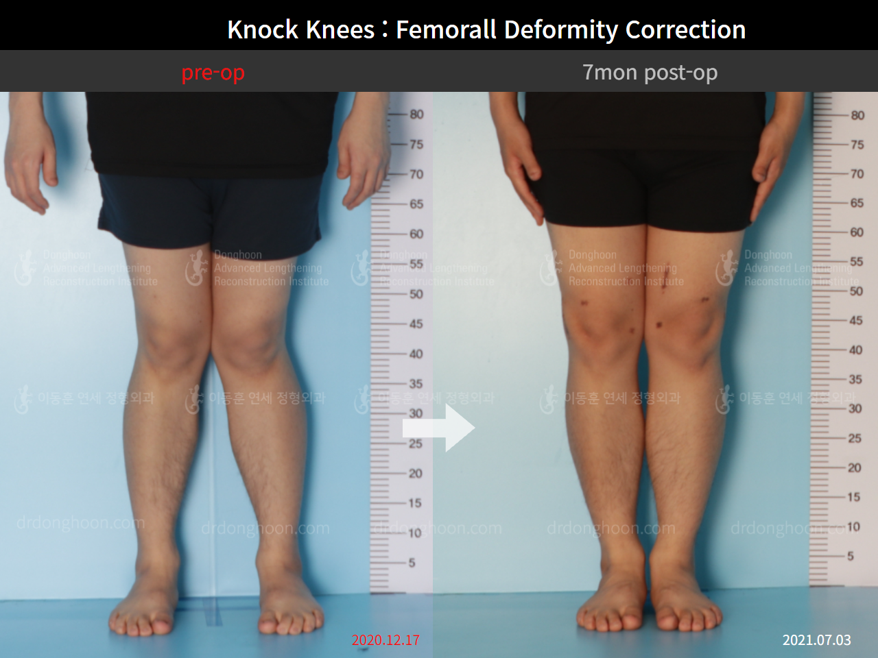 Before and after adult knock knees, case 8821218, image 1, Dr. Donghoon institute (DALRI)