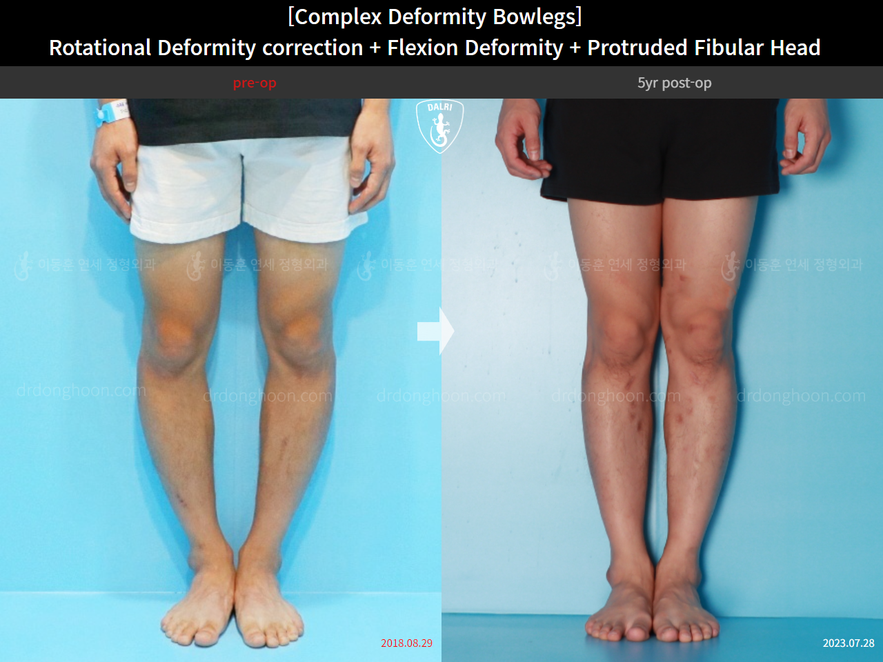 Before and after adult bowlegs, case 15944746, image 7, Dr. Donghoon institute (DALRI)