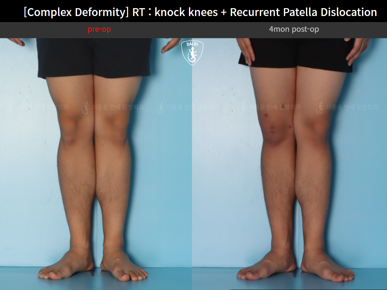 Before and after complex deformity, case 125841720, image 9, Dr. Donghoon institute (DALRI)