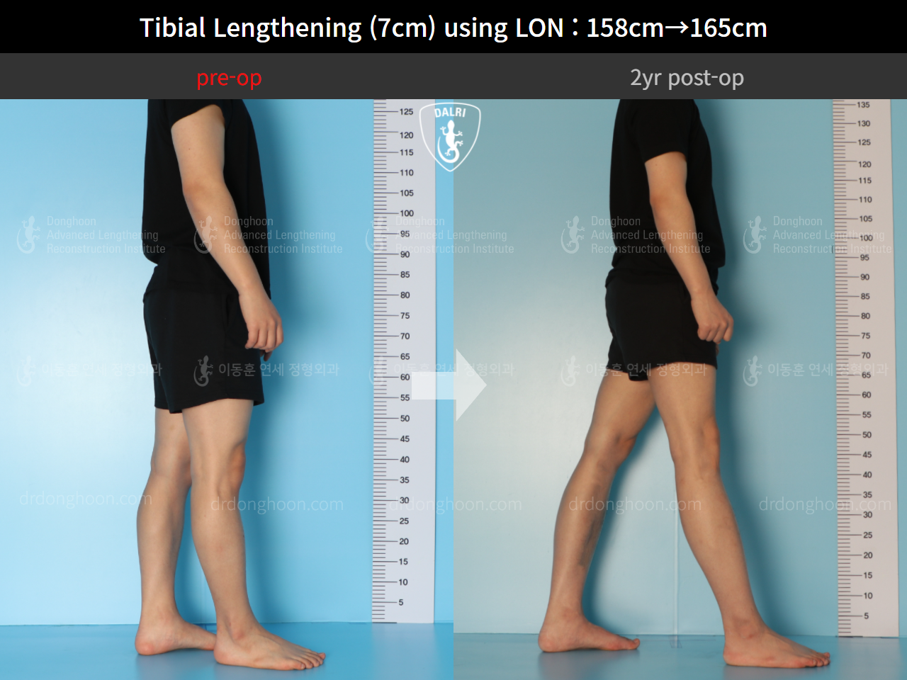 Before and after cll lon, case 9325768, image 3, Dr. Donghoon institute (DALRI)