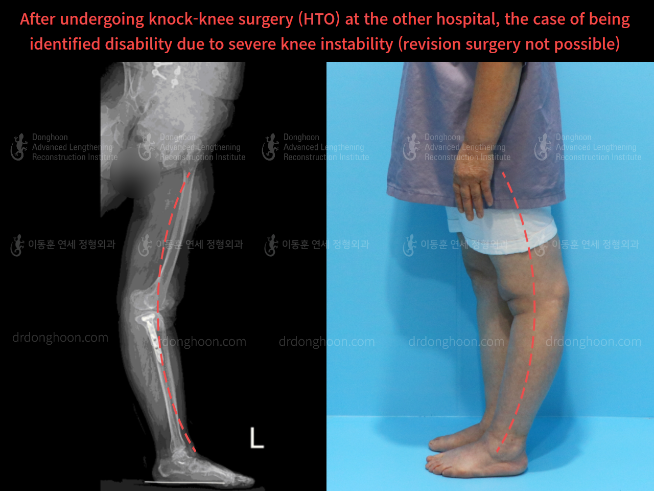 Before and after reoperation after deformity correction, case 4306331, image 2, Dr. Donghoon institute (DALRI)