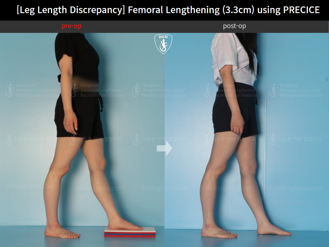 Before and after adult lld, case 22355841, image 4, Dr. Donghoon institute (DALRI)