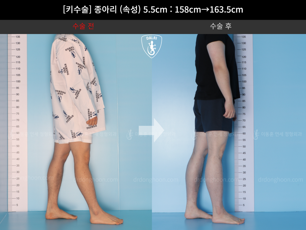 Before and after cll lon, case 4577764, image 3, Dr. Donghoon institute (DALRI)