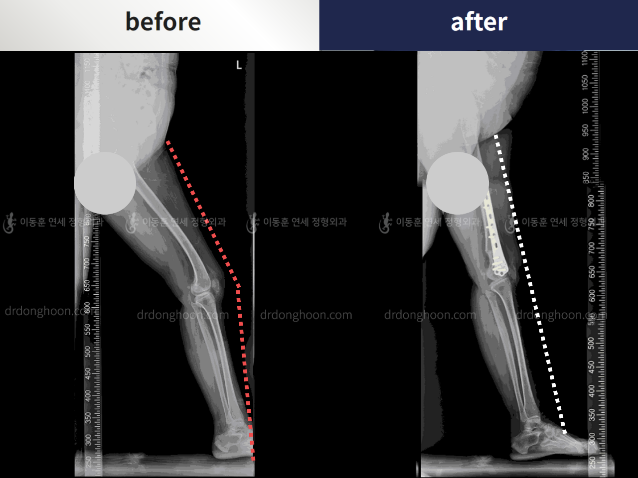 Before and after flexion deformity, case 6638601, image 1, Dr. Donghoon institute (DALRI)