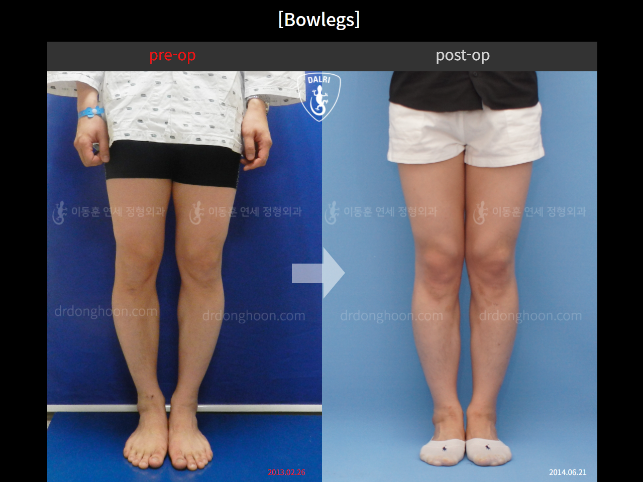 Before and after adult bowlegs, case 4311021, image 3, Dr. Donghoon institute (DALRI)