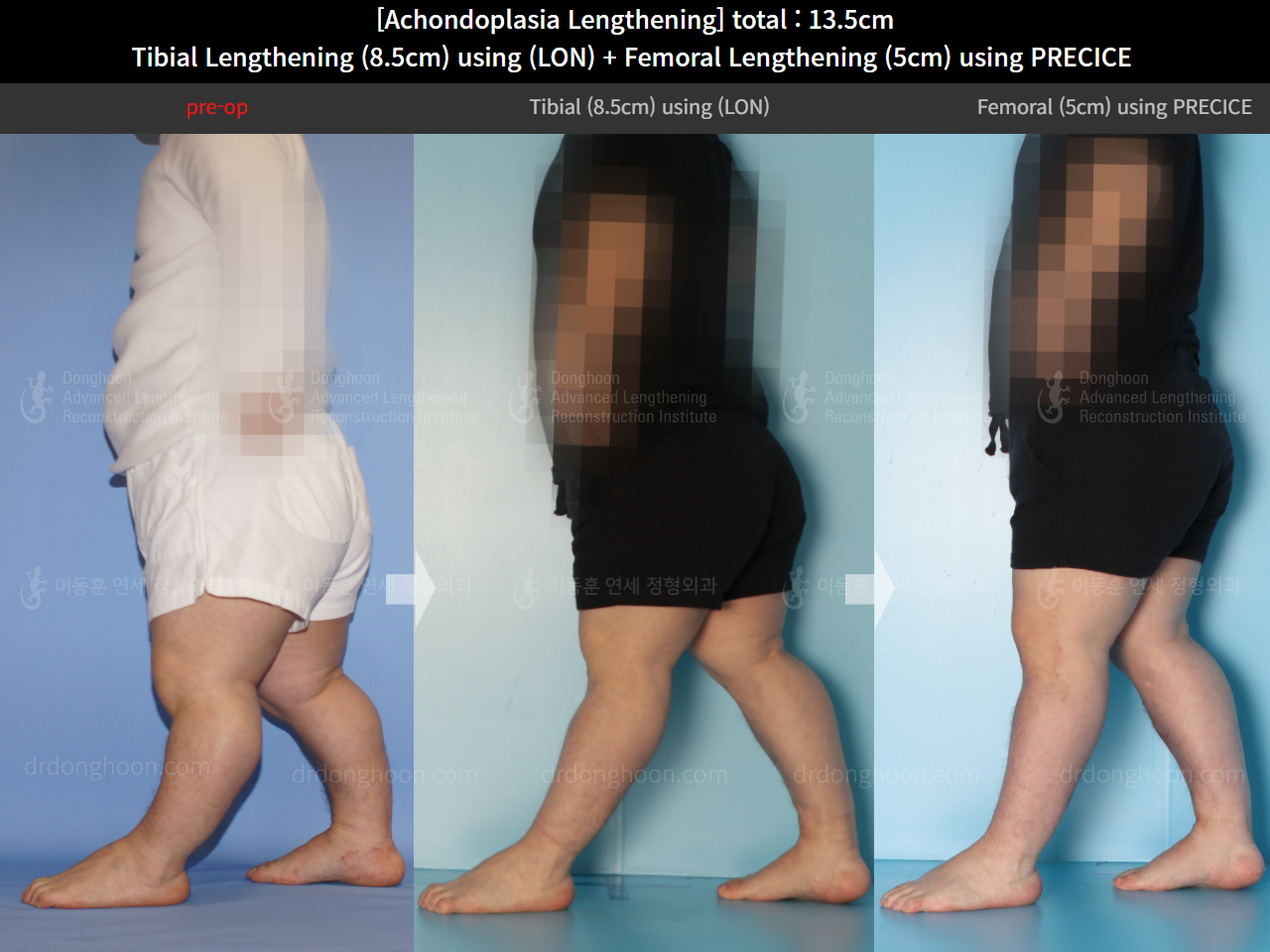 Before and after congenital condition, case 14993507, image 3, Dr. Donghoon institute (DALRI)