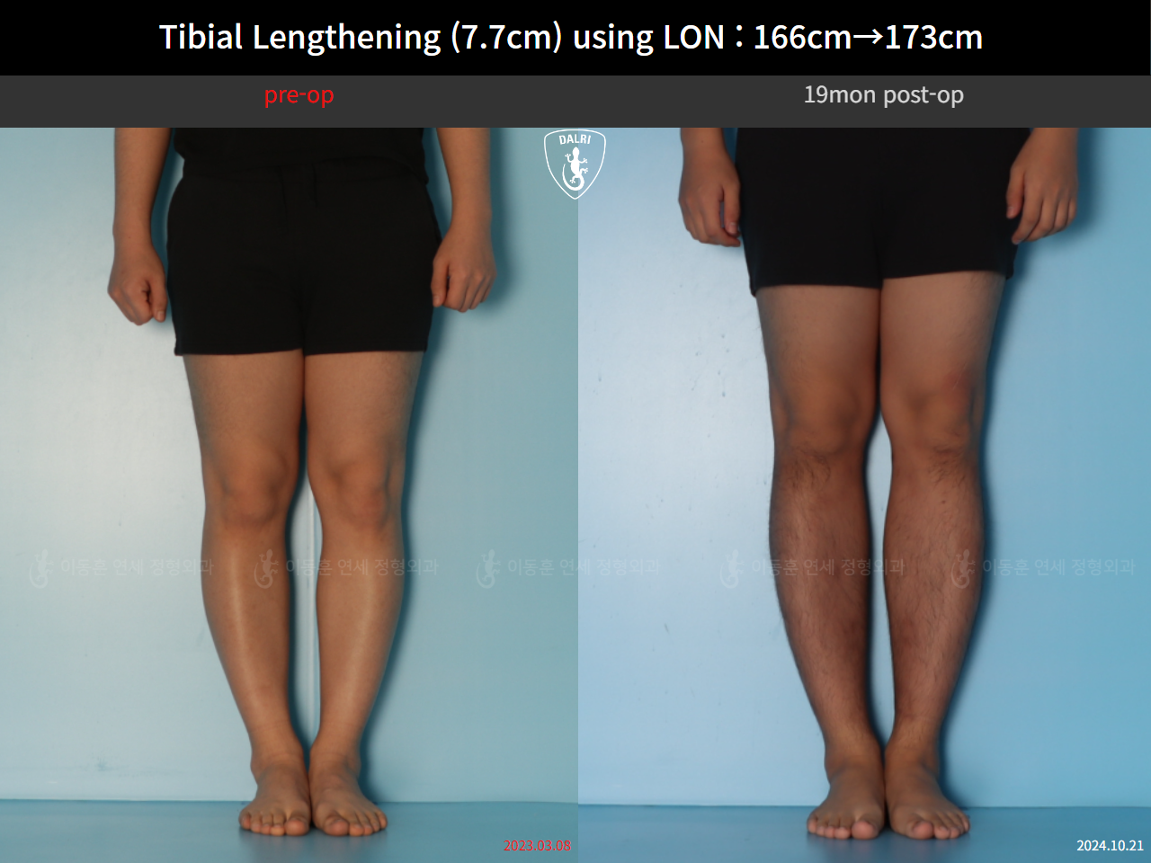 Before and after cll lon, case 126858222, image 5, Dr. Donghoon institute (DALRI)