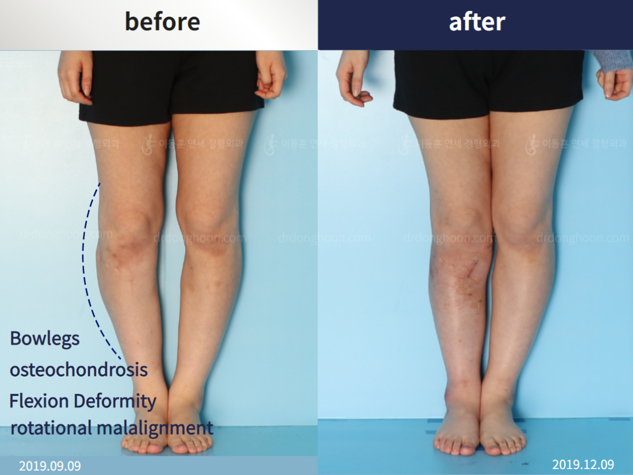 Before and after reoperation after deformity correction, case 4797441, image 1, Dr. Donghoon institute (DALRI)