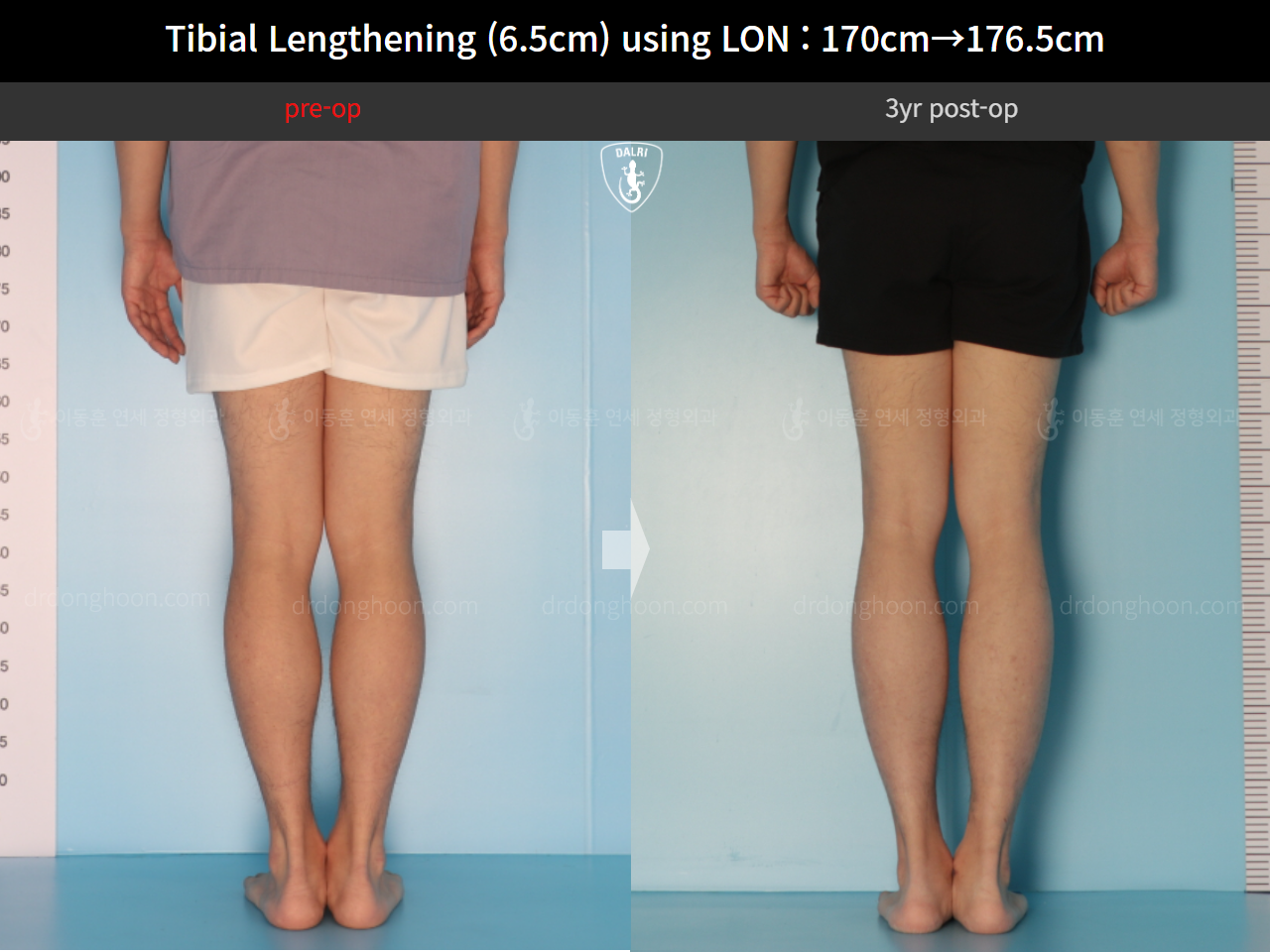 Before and after cll lon, case 16299082, image 6, Dr. Donghoon institute (DALRI)