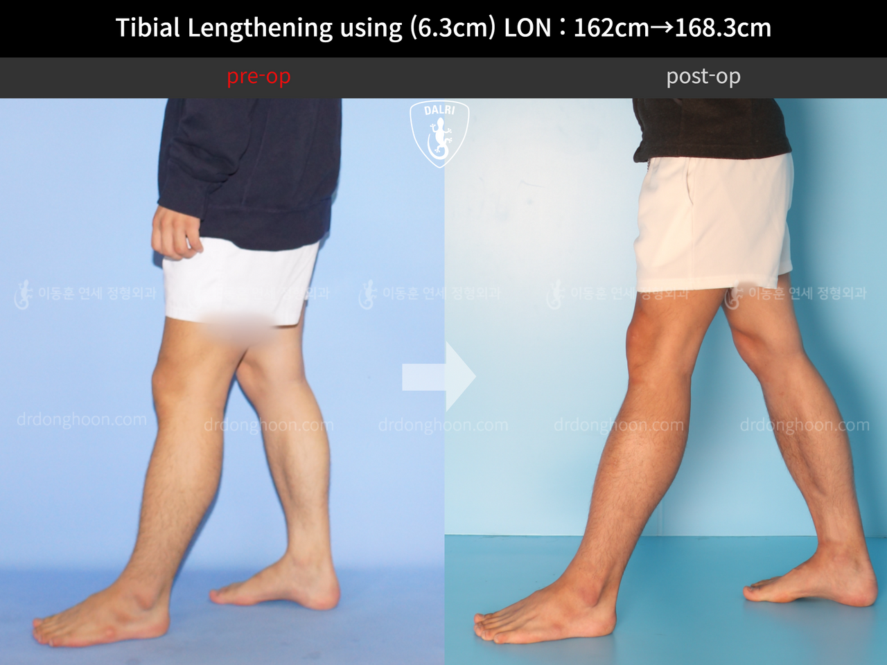 Before and after cll lon, case 12817675, image 6, Dr. Donghoon institute (DALRI)