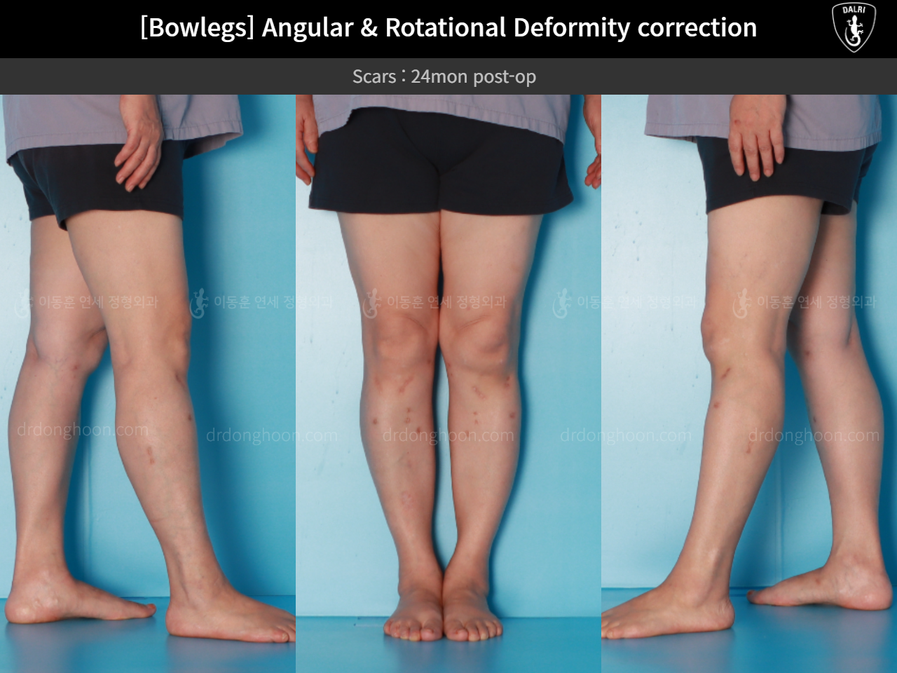 Before and after osteotomy for knee osteoarthritis, case 16074487, image 7, Dr. Donghoon institute (DALRI)