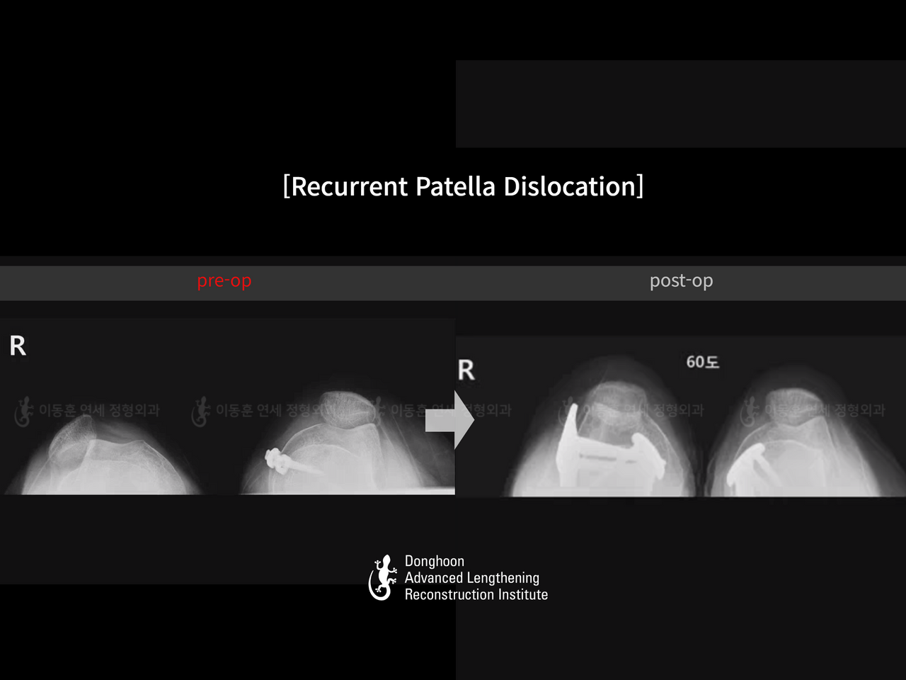 Before and after recurrent patella dislocation, case 14344405, image 5, Dr. Donghoon institute (DALRI)