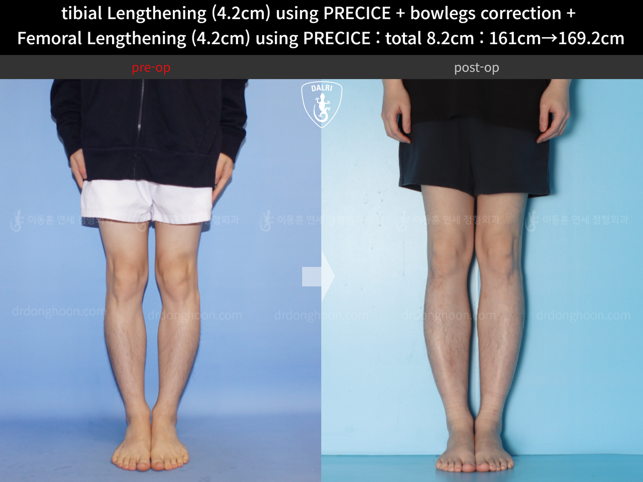 Before and after cll precice, case 14235714, image 5, Dr. Donghoon institute (DALRI)