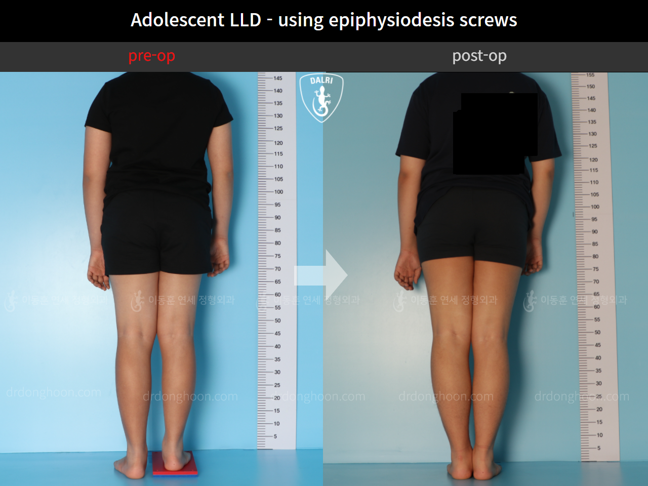 Before and after paediatric & adolescent lld, case 11472870, image 2, Dr. Donghoon institute (DALRI)
