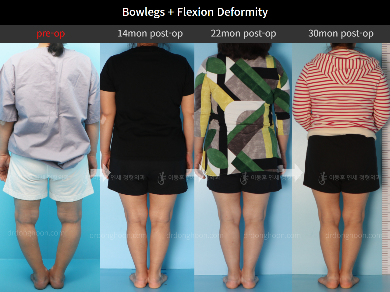 Before and after osteotomy for knee osteoarthritis, case 4586352, image 2, Dr. Donghoon institute (DALRI)