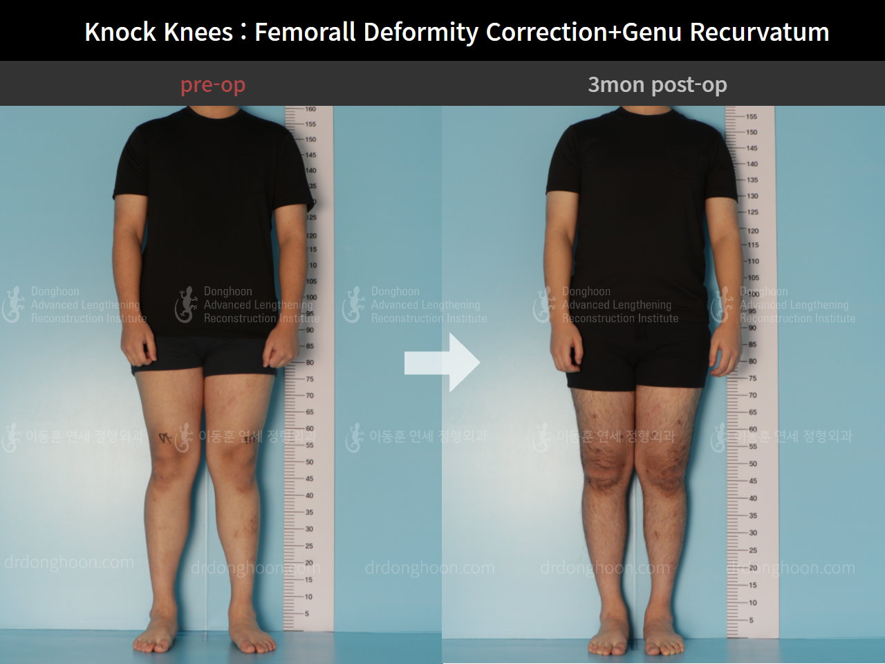 Before and after adult knock knees, case 7165631, image 1, Dr. Donghoon institute (DALRI)