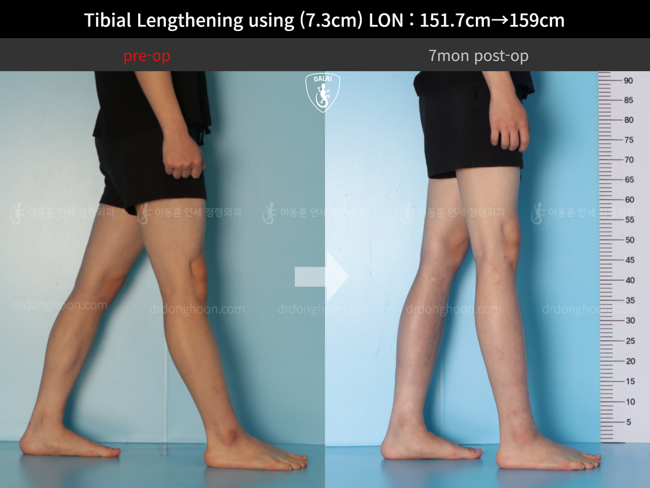 Before and after cll lon, case 13119336, image 7, Dr. Donghoon institute (DALRI)