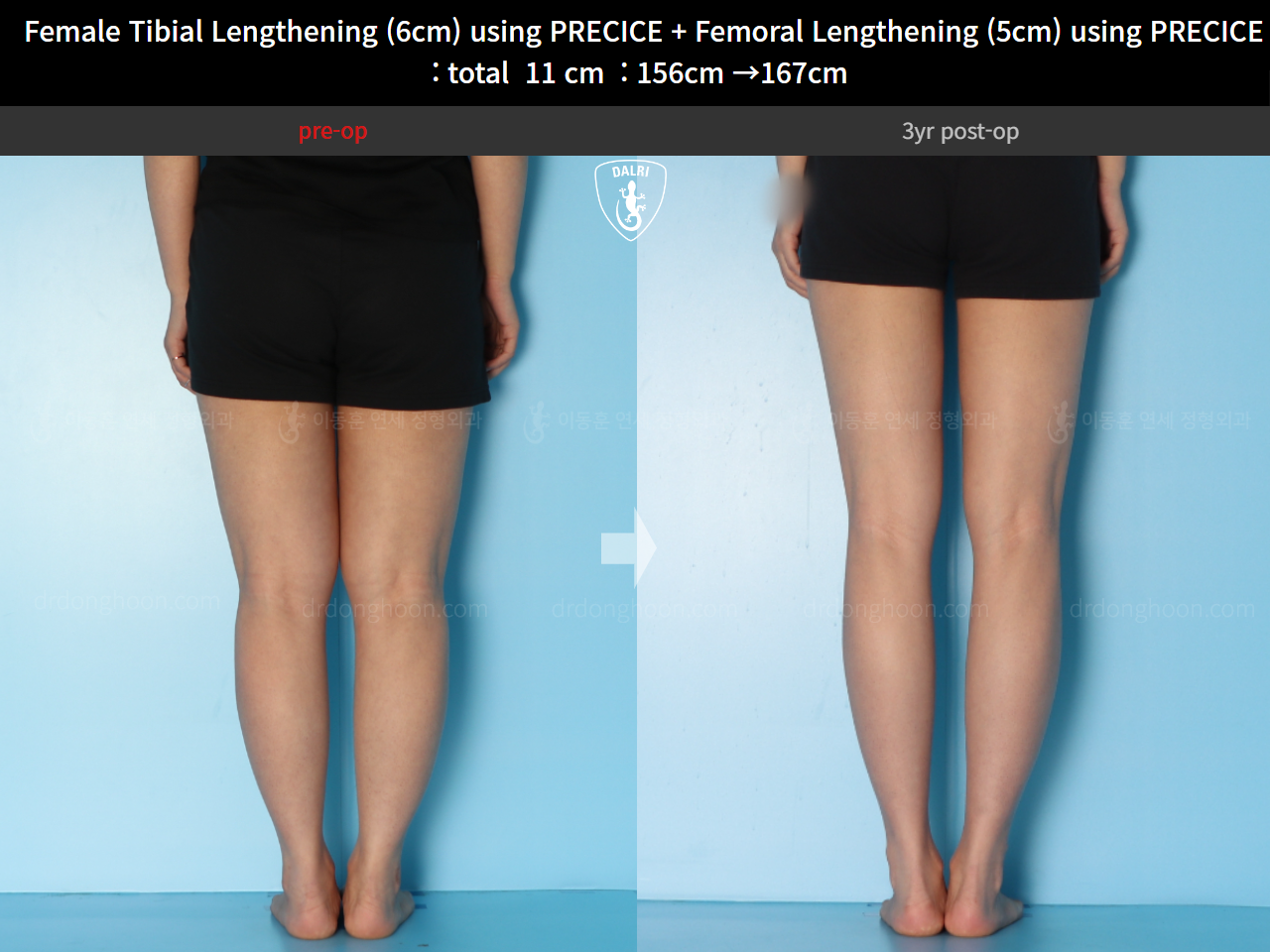 Before and after cll precice, case 24986271, image 6, Dr. Donghoon institute (DALRI)