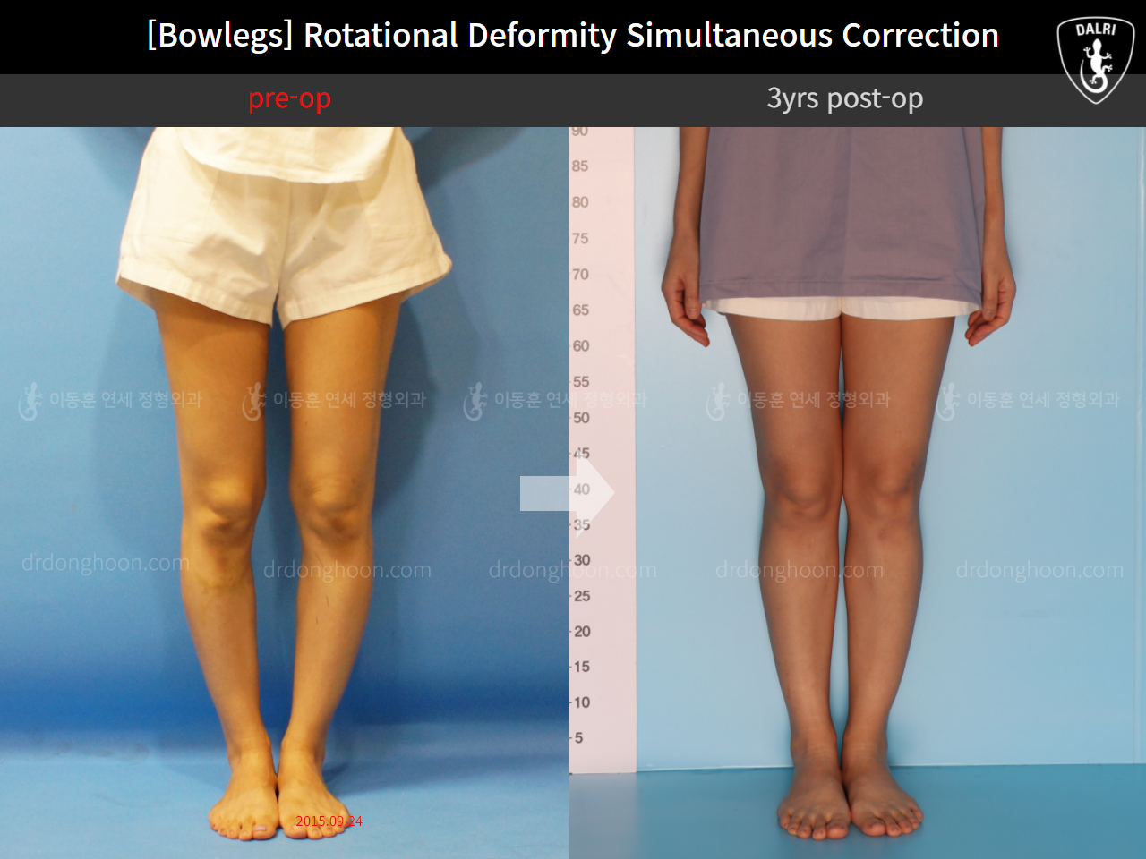 Before and after adult bowlegs, case 11789553, image 6, Dr. Donghoon institute (DALRI)
