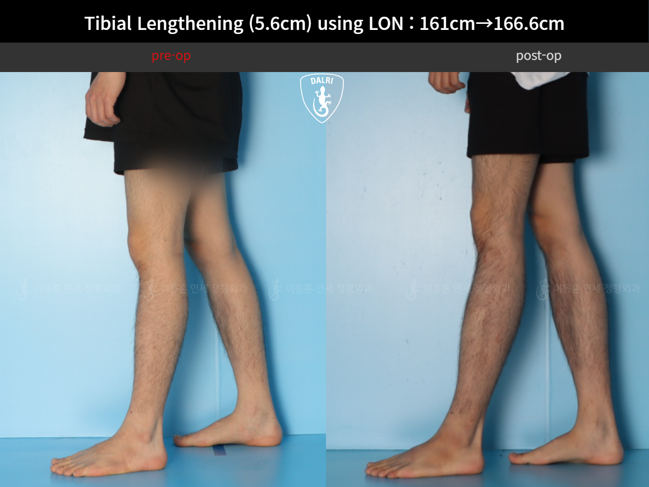 Before and after cll lon, case 126542150, image 7, Dr. Donghoon institute (DALRI)