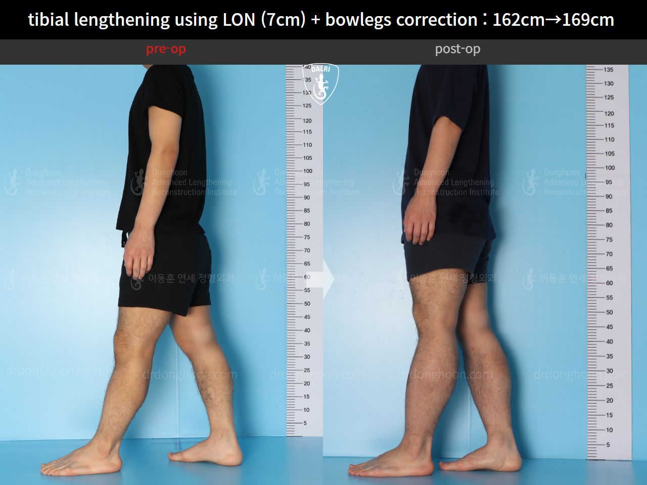 Before and after cll + deformity correction, case 15545055, image 4, Dr. Donghoon institute (DALRI)