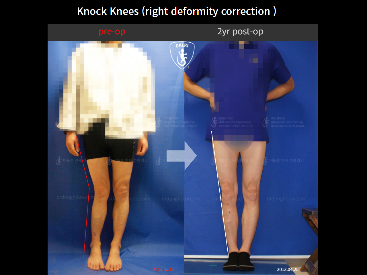 Before and after adult knock knees, case 4795610, image 2, Dr. Donghoon institute (DALRI)