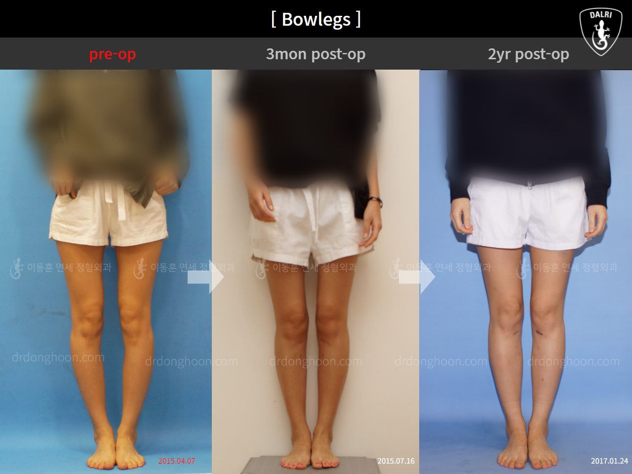 Before and after adult bowlegs, case 4311371, image 1, Dr. Donghoon institute (DALRI)