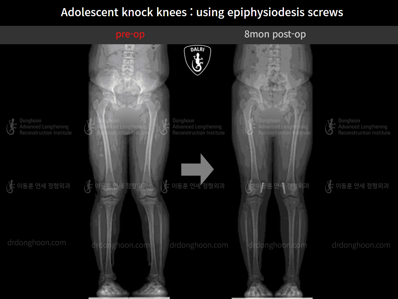 Before and after paediatric & adolescent knock knees, case 9743785, image 6, Dr. Donghoon institute (DALRI)