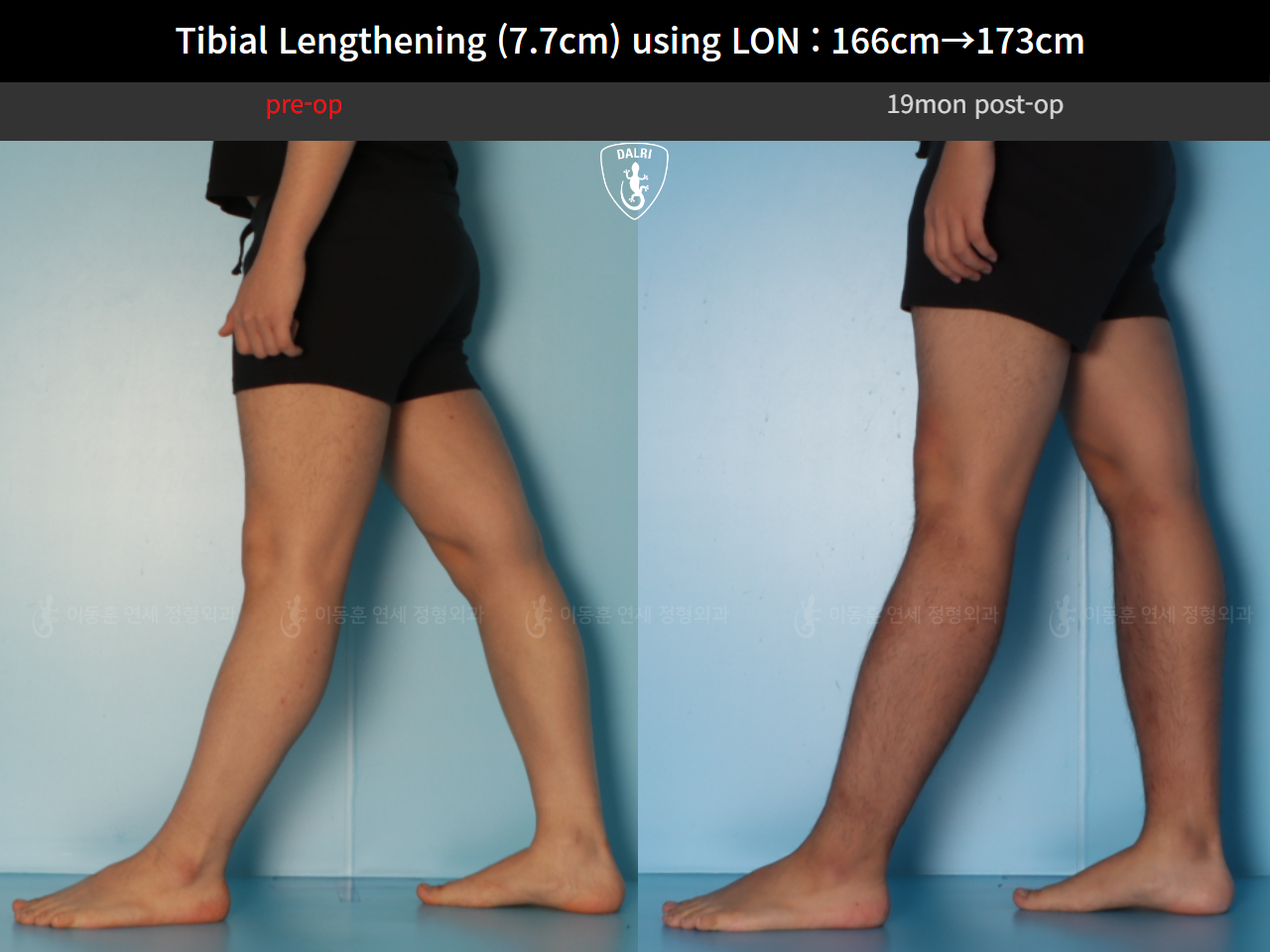 Before and after cll lon, case 126858222, image 7, Dr. Donghoon institute (DALRI)