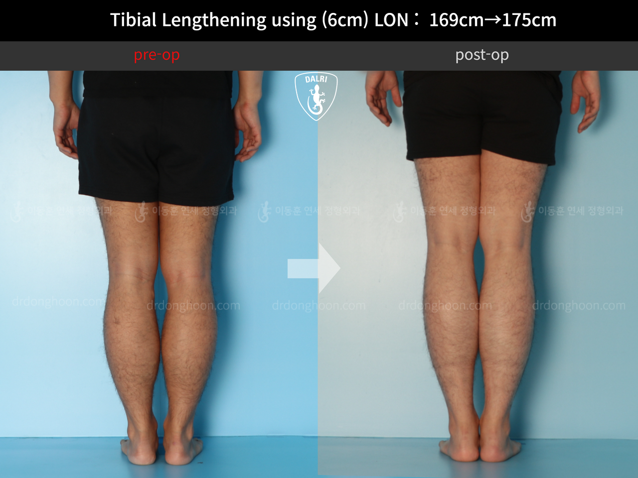 Before and after cll lon, case 12279515, image 6, Dr. Donghoon institute (DALRI)