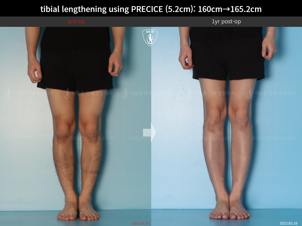 Before and after cll precice, case 15213098, image 9, Dr. Donghoon institute (DALRI)