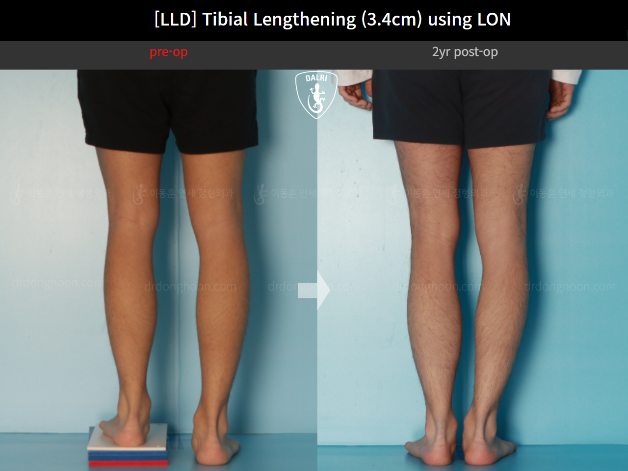Before and after adult lld, case 17538143, image 6, Dr. Donghoon institute (DALRI)