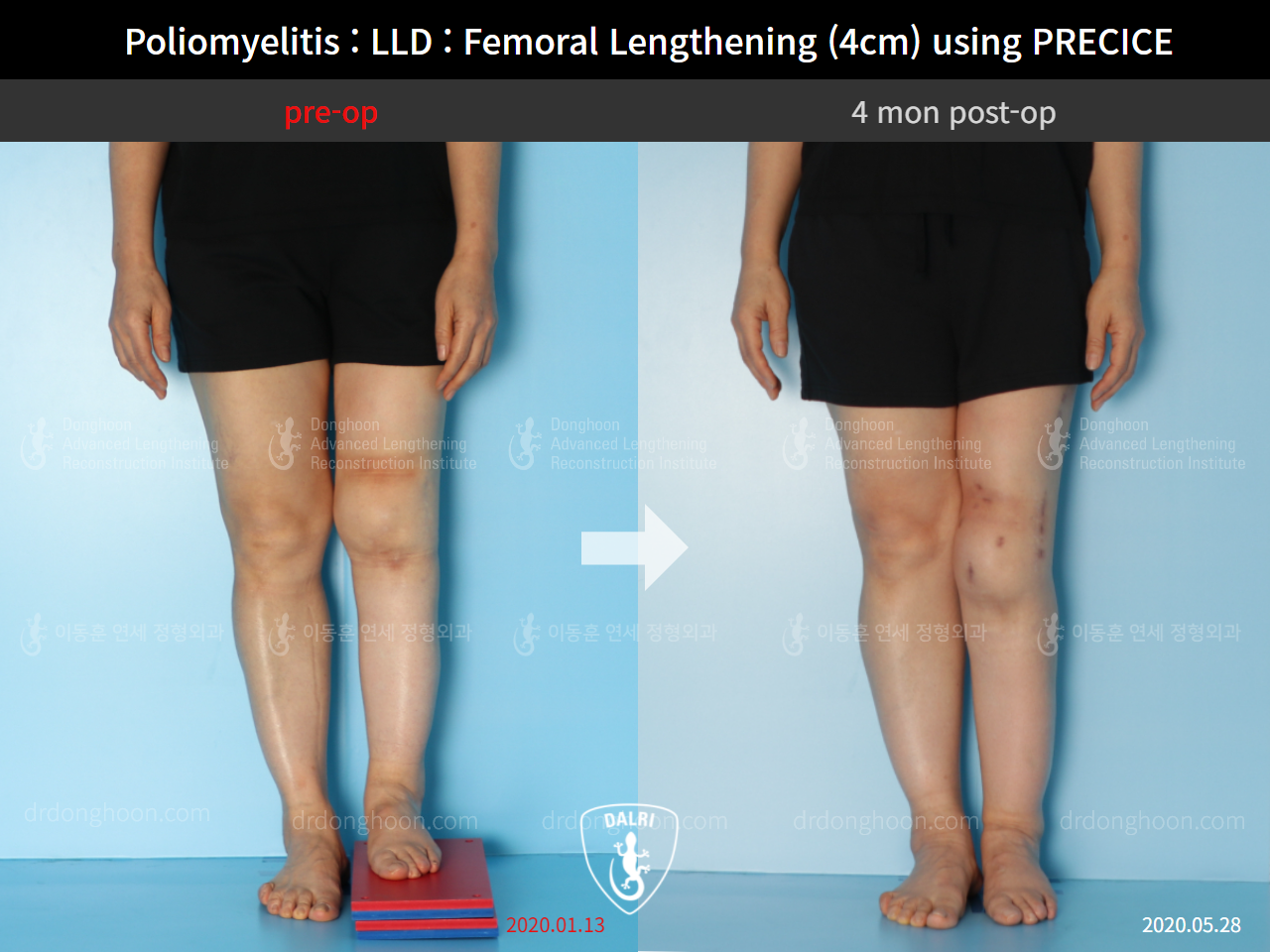 Before and after congenital condition, case 9191055, image 4, Dr. Donghoon institute (DALRI)