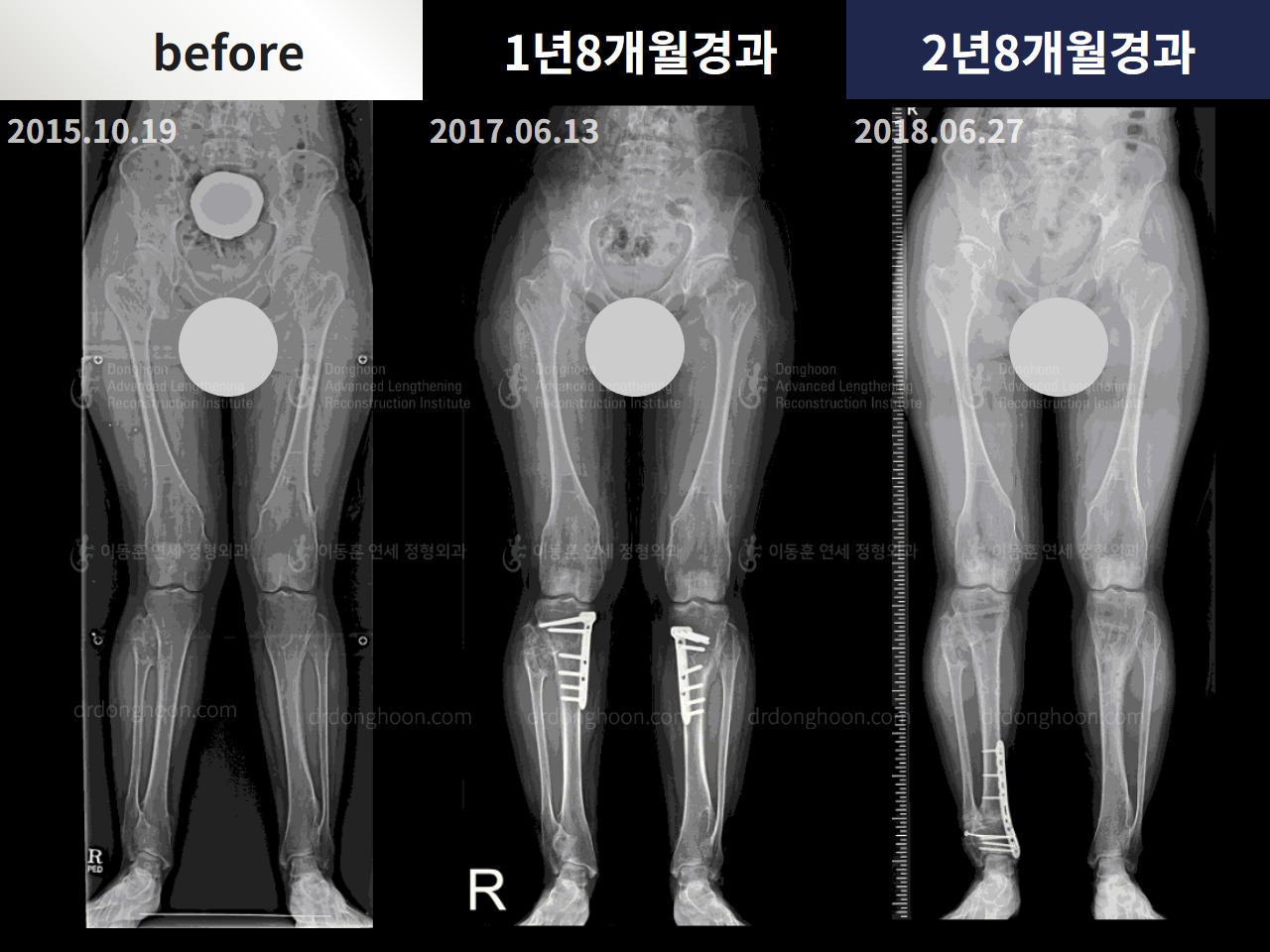 Before and after adult knock knees, case 4310863, image 3, Dr. Donghoon institute (DALRI)