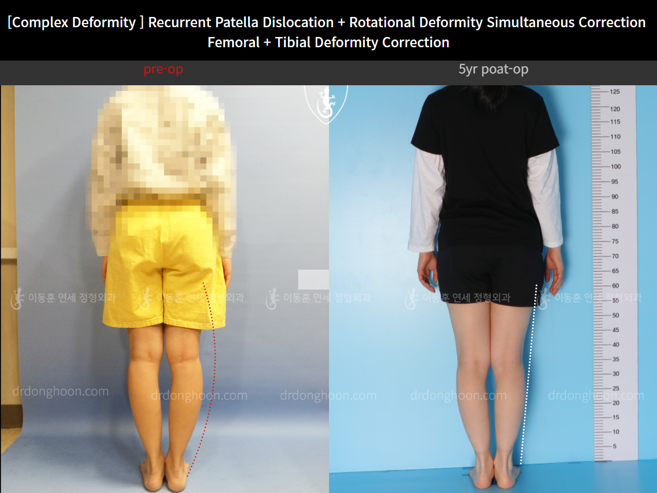 Before and after recurrent patella dislocation, case 10475088, image 4, Dr. Donghoon institute (DALRI)