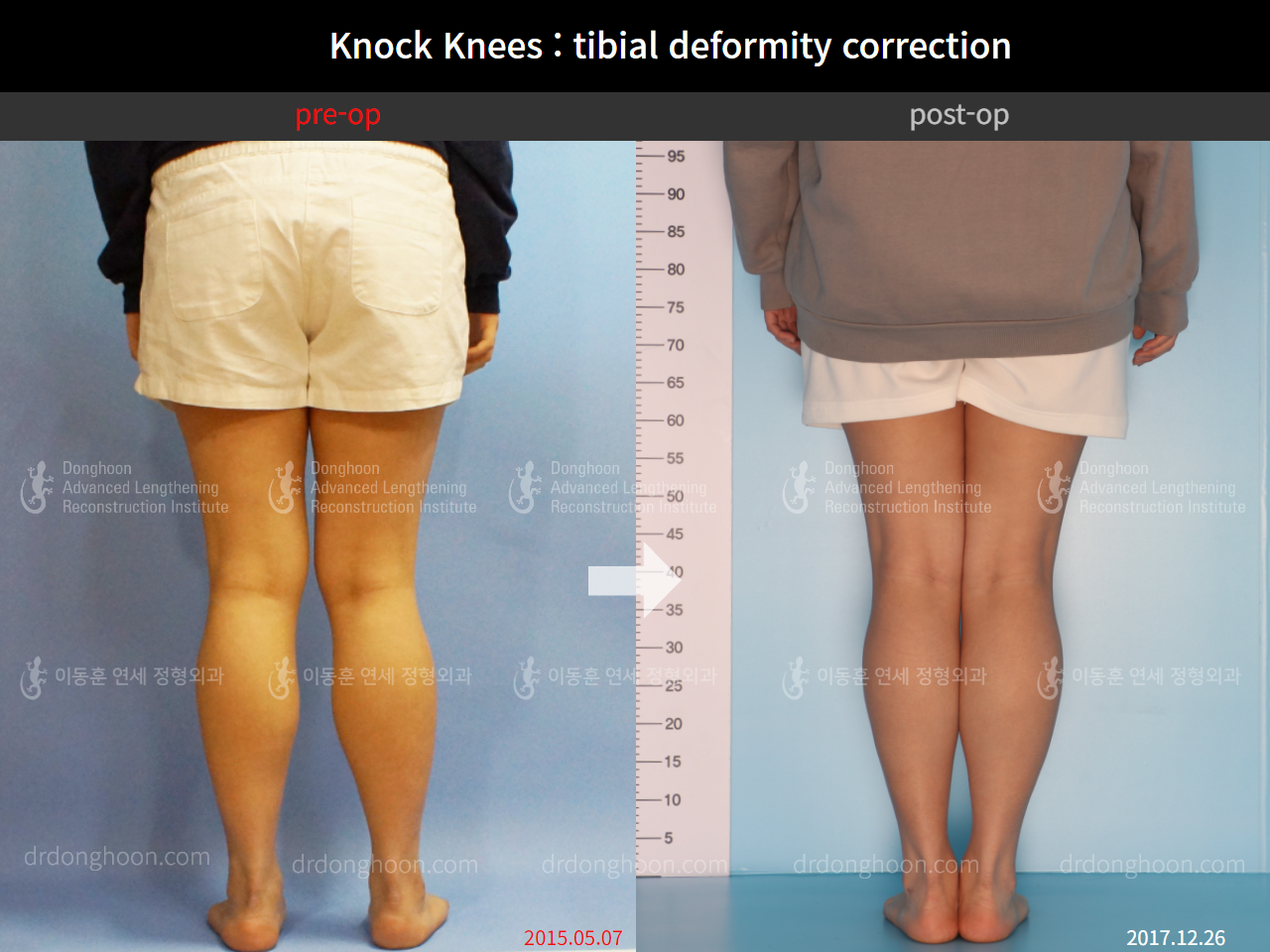 Before and after adult knock knees, case 4586314, image 4, Dr. Donghoon institute (DALRI)