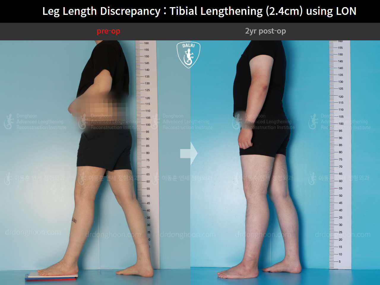 Before and after adult lld, case 15877698, image 3, Dr. Donghoon institute (DALRI)