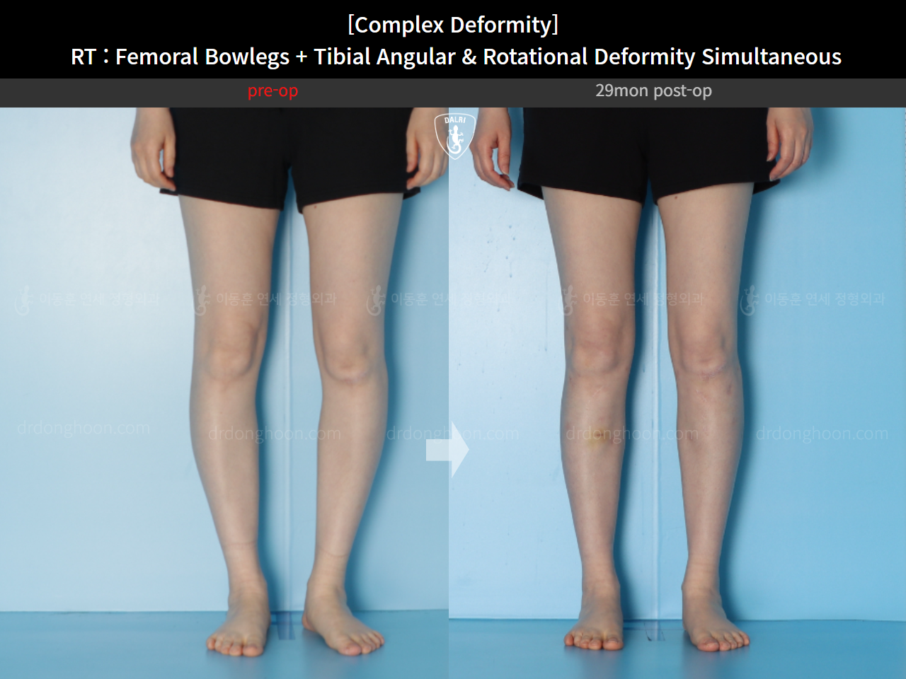 Before and after adult bowlegs, case 14771490, image 8, Dr. Donghoon institute (DALRI)