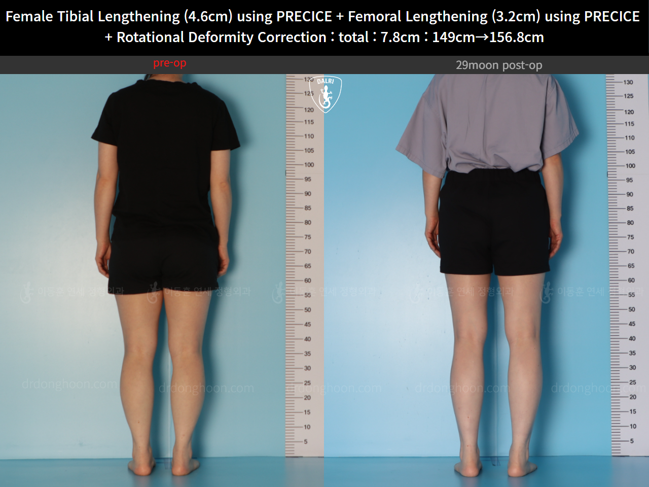 Before and after cll precice, case 123686647, image 4, Dr. Donghoon institute (DALRI)