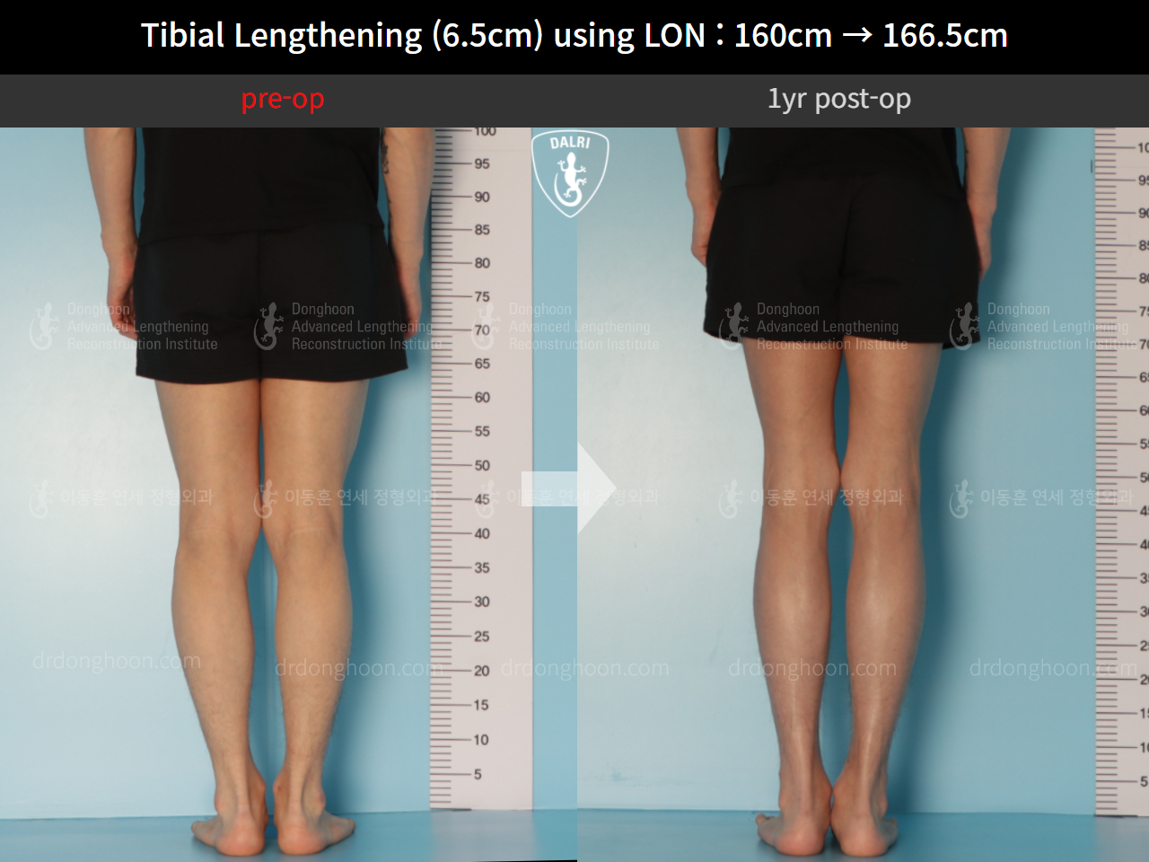 Before and after cll lon, case 10293105, image 6, Dr. Donghoon institute (DALRI)