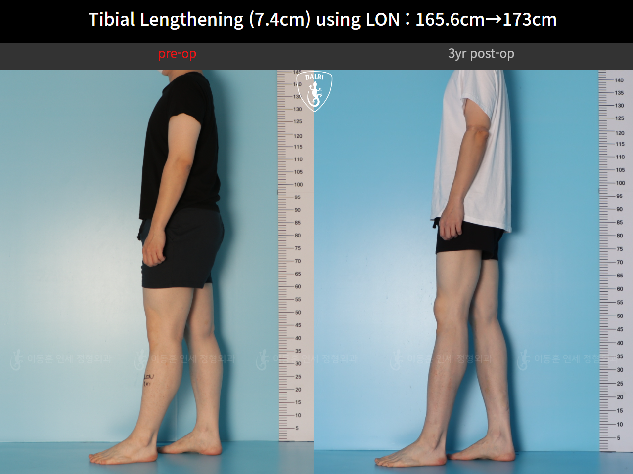 Before and after cll lon, case 125561518, image 5, Dr. Donghoon institute (DALRI)
