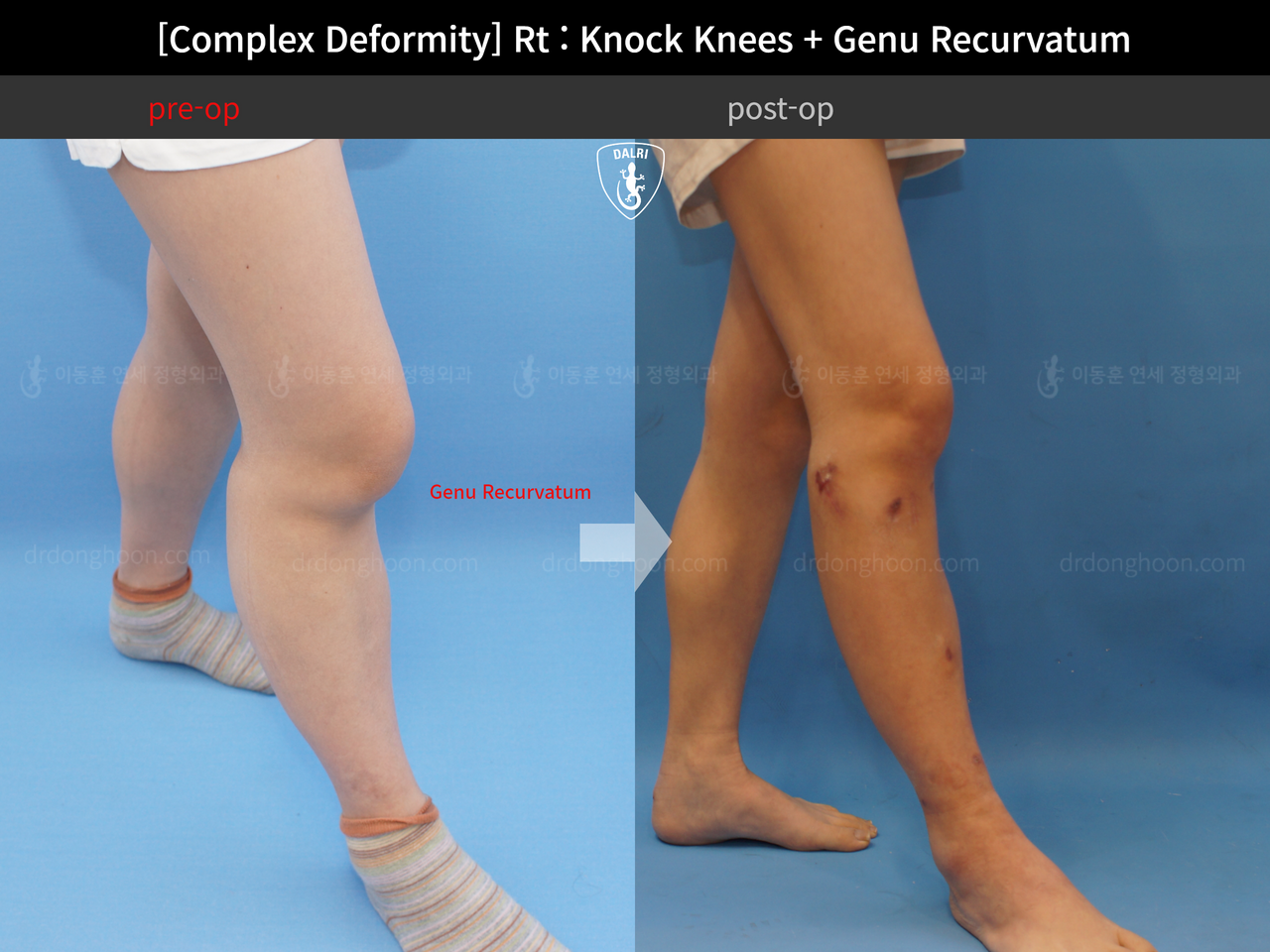 Before and after complex deformity, case 13204696, image 5, Dr. Donghoon institute (DALRI)